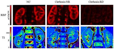 T1 mapping combined with arterial spin labeling MRI to identify renal injury in patients with liver cirrhosis